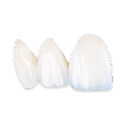 emax-zirconia