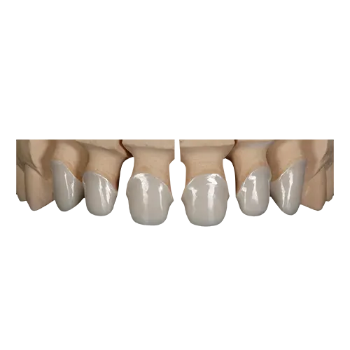 Zirconia Coping