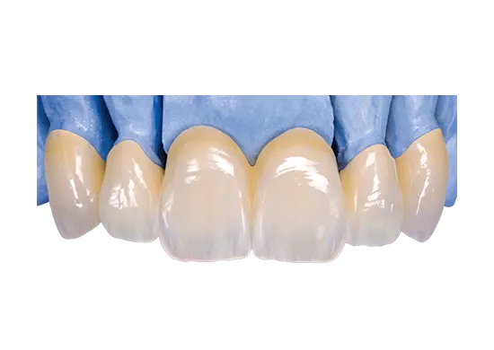 Ultra Translucent Monolithic Zirconia