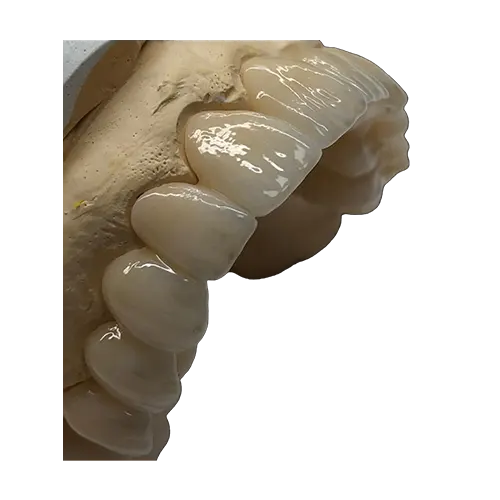 porcelain fused to zirconia