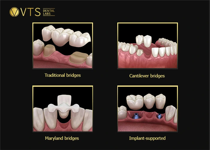 Factors Affecting Dental Bridge Cost