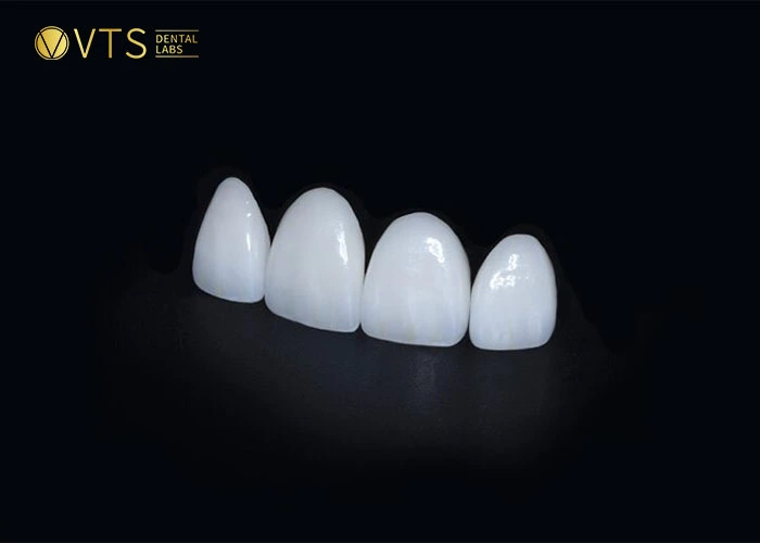 Emax is most expensive dental bridge cost