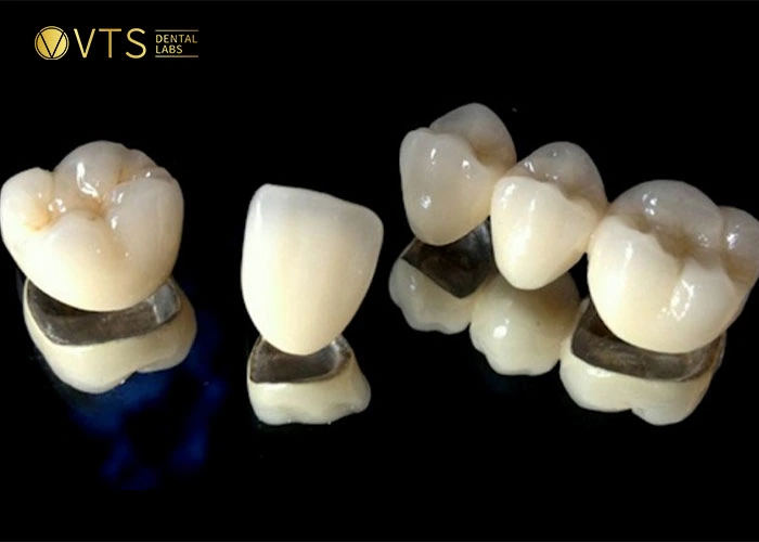 PFM is the most saved dental bridge cost