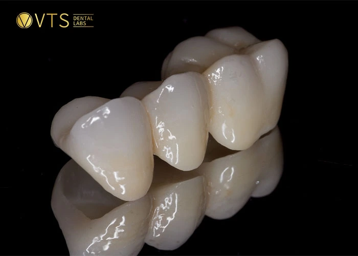 Full Zirconia: The popular ceramic bridge