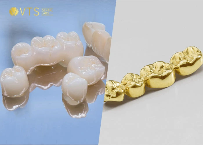 Ceramic vs. Full-Cast Metal 