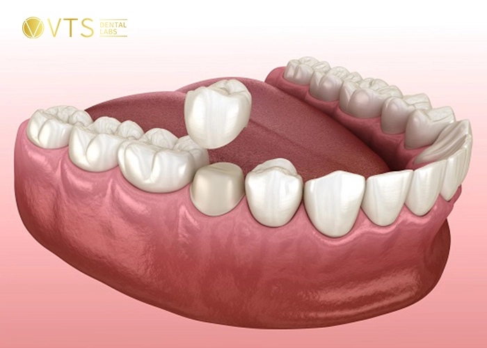 crowns-vs-implants-1