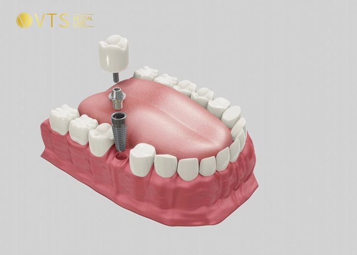 crowns-vs-implants-2