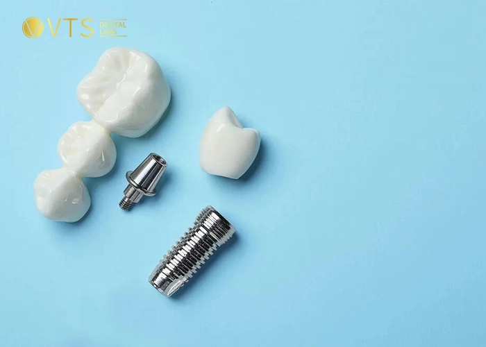 crowns-vs-implants-4