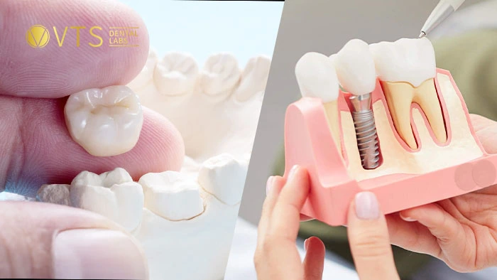 crowns-vs-implants