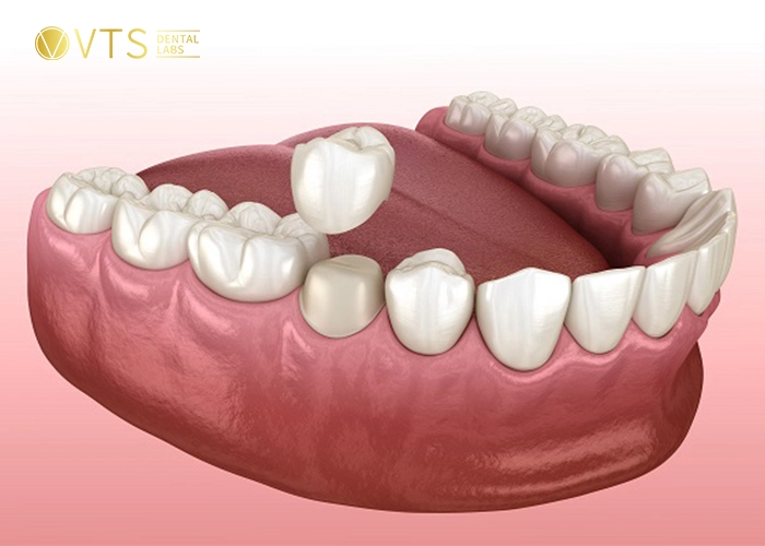 dental-crowns-and-bridges-1