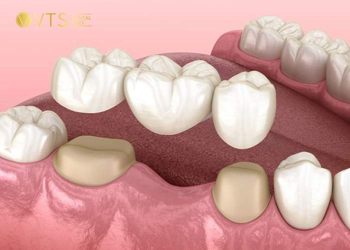 dental-crowns-and-bridges-2