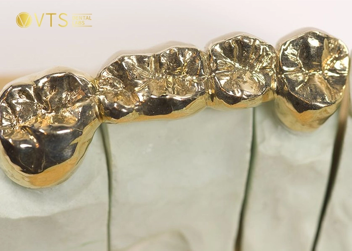 dental-crowns-and-bridges-5