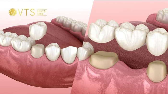 dental-crowns-and-bridges