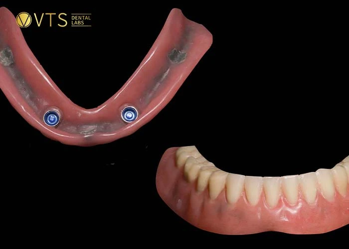 acrylic-denture-5