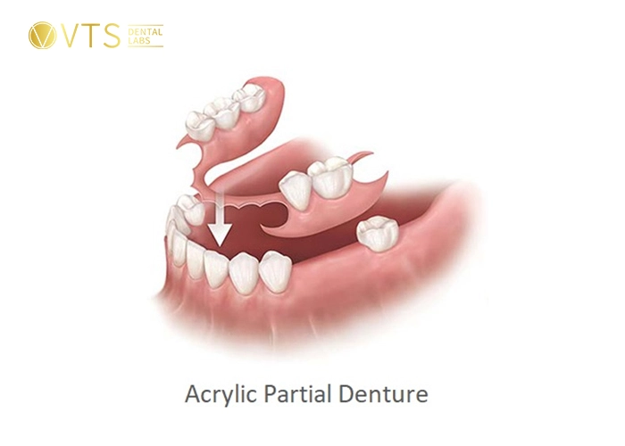 acrylic-partial-denture-1