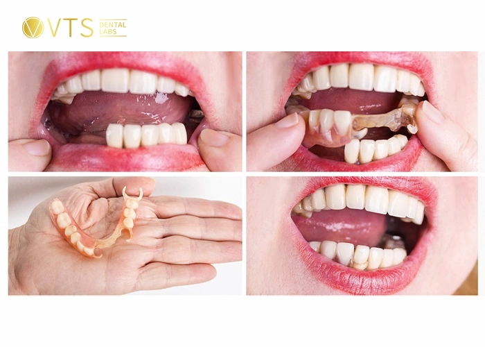 acrylic-partial-denture-4