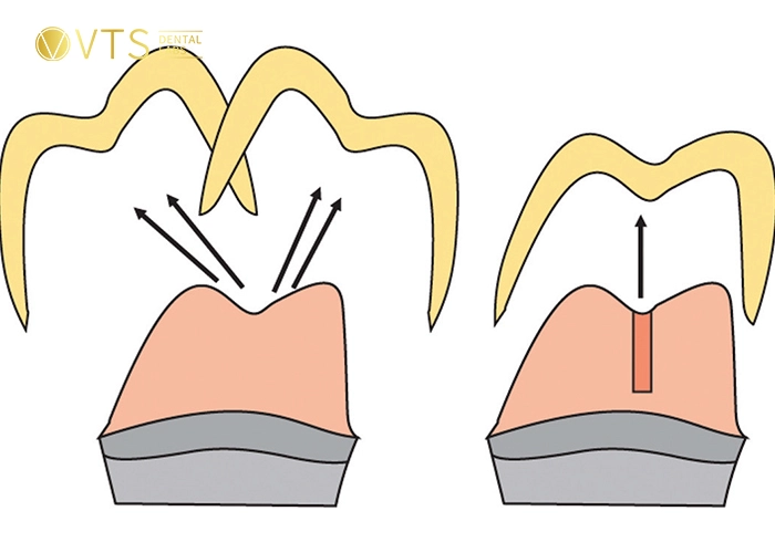 dental-crown-4