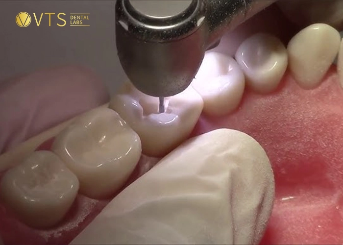 dental-crown-5