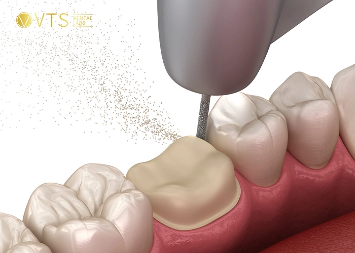 dental-crown-8