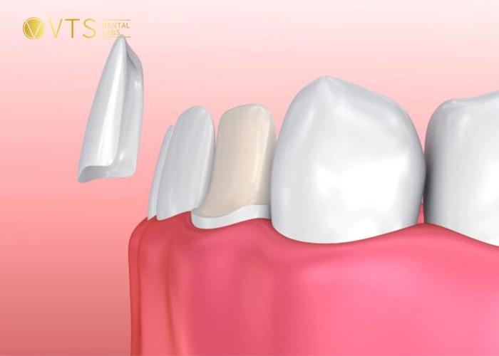 veneers & crowns