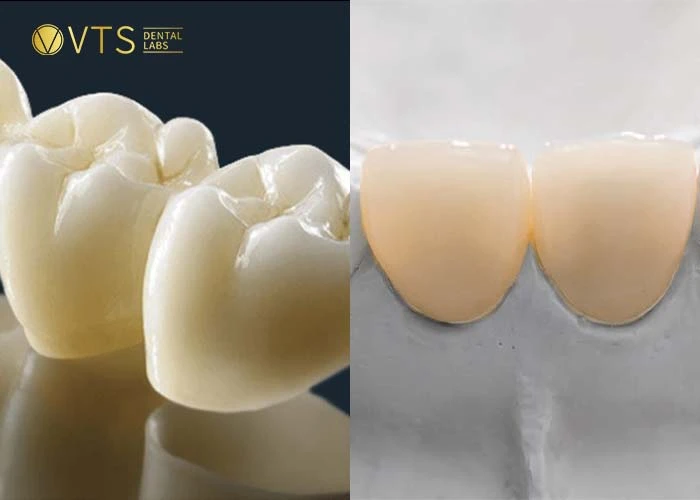 zirconia-crown-11