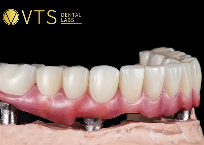 Denture-Costs-A-Comprehensive-Breakdown-for-Better-Decision-Making