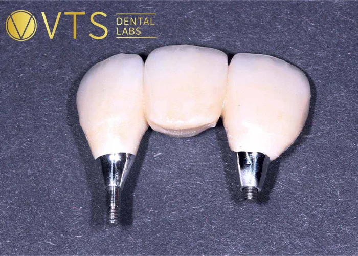 Fixed-Partial-Denture-Discover-The-Ultimate-Solution-For-Tooth-Loss