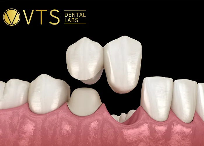 Fixed-Partial-Denture-Discover-The-Ultimate-Solution-For-Tooth-Loss