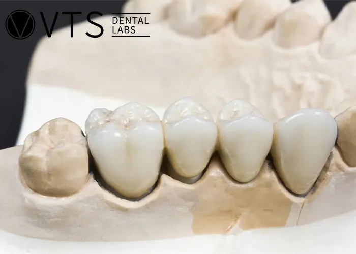 Fixed-Partial-Denture-Discover-The-Ultimate-Solution-For-Tooth-Loss