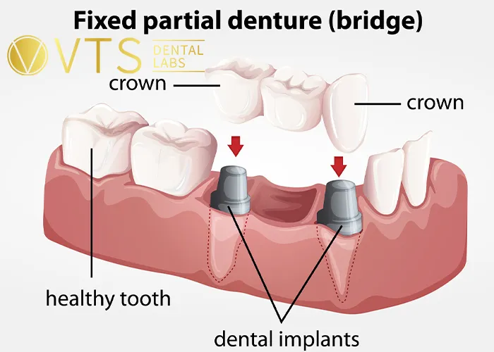 Fixed-Partial-Denture-Discover-The-Ultimate-Solution-For-Tooth-Loss