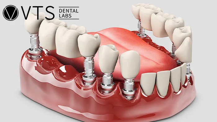 Fixed-Partial-Denture-Discover-The-Ultimate-Solution-For-Tooth-Loss