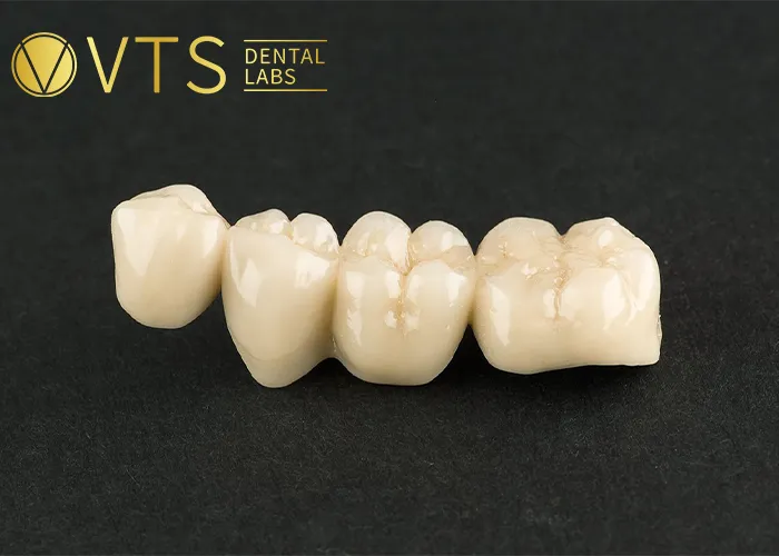 Fixed-Partial-Denture-Discover-The-Ultimate-Solution-For-Tooth-Loss