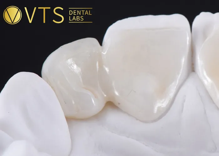 Fixed-Partial-Denture-Discover-The-Ultimate-Solution-For-Tooth-Loss
