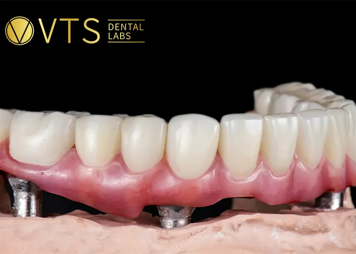 Fixed-Partial-Denture-Discover-The-Ultimate-Solution-For-Tooth-Loss