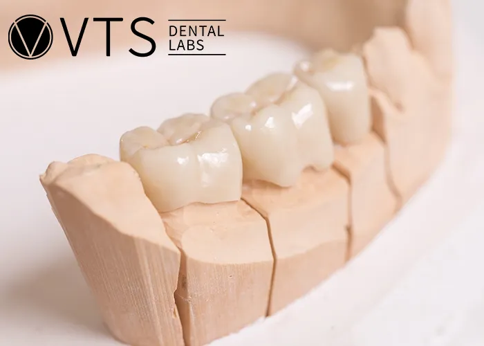 Fixed-Partial-Denture-Discover-The-Ultimate-Solution-For-Tooth-Loss