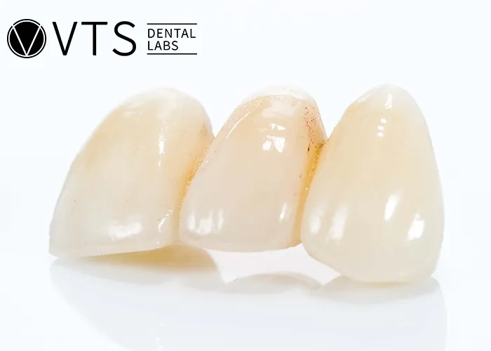 Fixed-Partial-Denture-Discover-The-Ultimate-Solution-For-Tooth-Loss