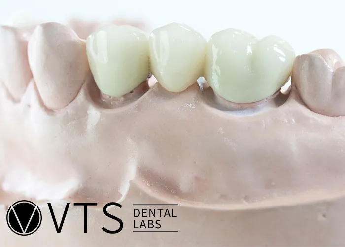 Fixed-Partial-Denture-Discover-The-Ultimate-Solution-For-Tooth-Loss