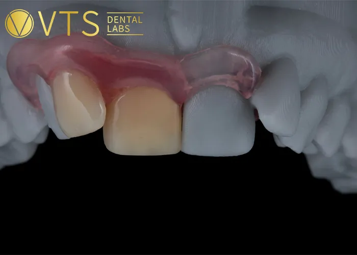 The-Undeniable-Advantages-of-Flexible-Dentures-in-Modern-Dentistry