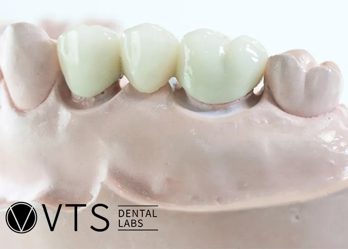 Flexible-Partial-Denture-vs.-Fixed-Which-One-Truly-Fits-Your-Needs?