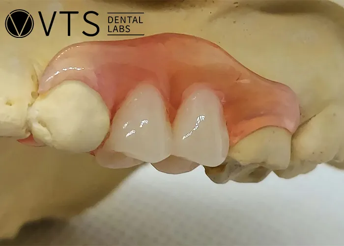 Flexible-Partial-Denture-vs.-Fixed-Which-One-Truly-Fits-Your-Needs?