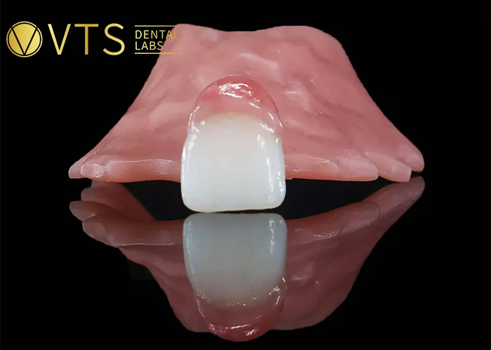 One-Tooth-Denture -The-Optimal-Solution-for-Dentists-and-Patients