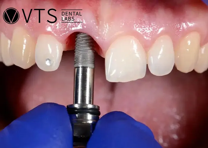 One-Tooth-Denture -The-Optimal-Solution-for-Dentists-and-Patients