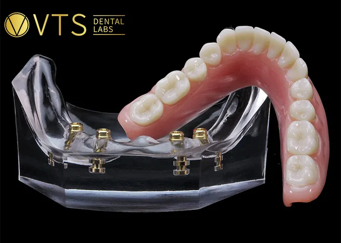 Overdentures-Expert-Tips-for-Optimal-Restoration