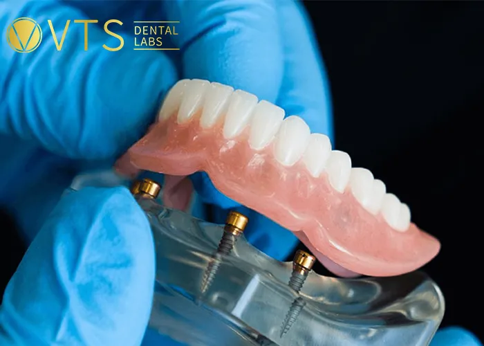 Overdentures-Expert-Tips-for-Optimal-Restoration
