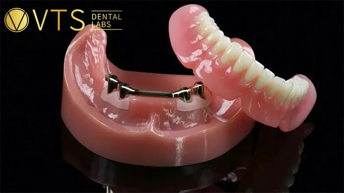 Overdentures-Expert-Tips-for-Optimal-Restoration