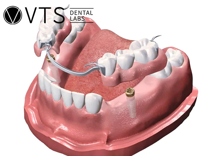 Overdentures-Expert-Tips-for-Optimal-Restoration