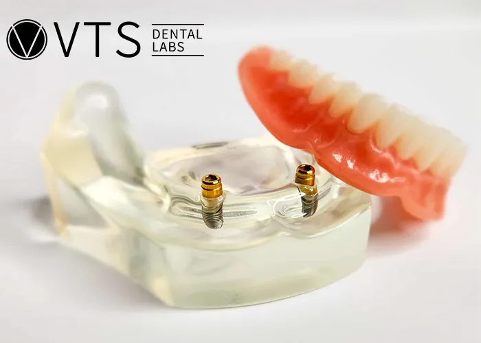 Overdentures-Expert-Tips-for-Optimal-Restoration
