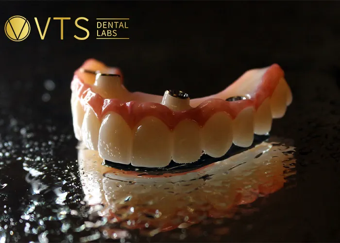 Overdentures-Expert-Tips-for-Optimal-Restoration