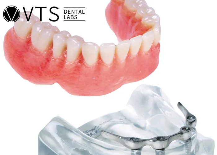 Overdentures-Expert-Tips-for-Optimal-Restoration