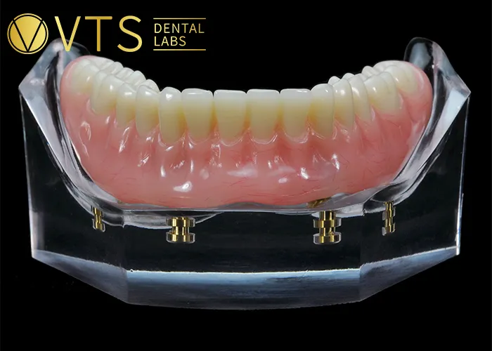 Overdentures-Expert-Tips-for-Optimal-Restoration